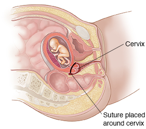 Cross section of female pelvis and abdomen highlighting urogenital tract. A suture is placed around the cervix.