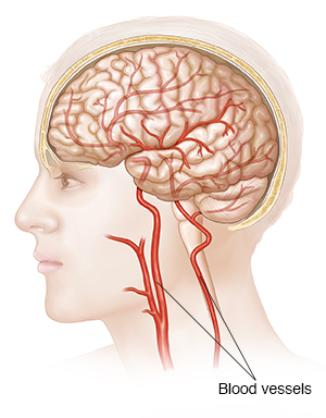 Side view of head, brain, and blood vessels to the brain.