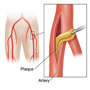 Carotid artery showing incision with instrument removing plaque and shunt rerouting blood flow.