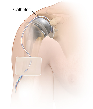 Front view of upper arm showing humerus. A catheter is inserted into the glenohumeral joint.