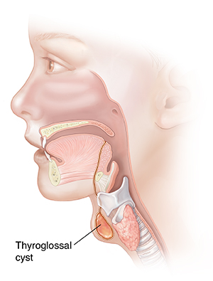 Side view of head showing a thyroglossal cyst.