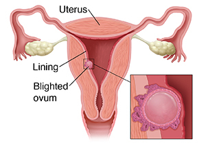 Cross section of female reproductive tract with inset showing blighted ovum.