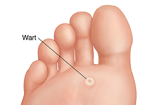 Sole of foot showing plantar wart.