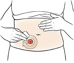 Closeup of  abdomen showing hands applying skin barrier around stoma. 