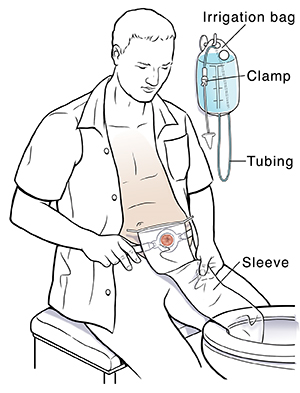 stoma cone irrigator kit