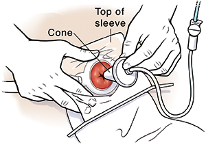 Hand inserting irrigation cone into stoma.
