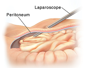 Cross section side view of lower abdomen showing laparoscope entering body through peritoneum. 