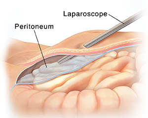 Cross section side view of lower abdomen showing laparoscope entering body above peritoneum.