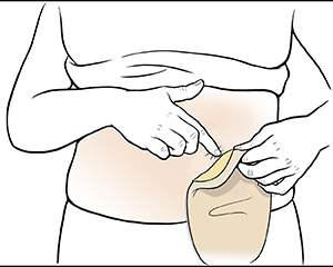 Female abdomen showing hands removing ostomy pouch.