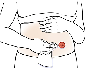 Female abdomen showing hands cleaning around stoma.