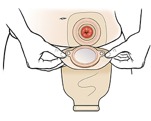 Hands placing ostomy pouch over stoma.