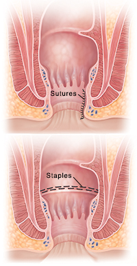 Cross section of anus showing sutures. Cross section of anus showing staples.
