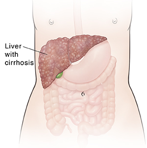 Front view of female outline showing digestive system and liver with cirrhosis.