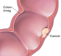 Cross section of segment of colon showing cancer.
