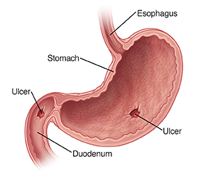Cross section of stomach showing ulcers in stomach and duodenum.