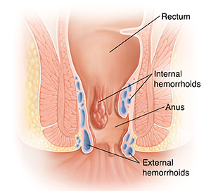 Cross section of rectum and anus showing hemorrhoids.