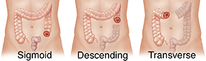 Front view of three male abdomens with colon ghosted in showing sigmoid, descending, and transverse colostomy.