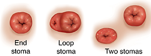 Front view of end stoma, loop stoma, and two stomas.