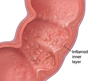 Cross section of sigmoid colon segment with inflammatory disease.