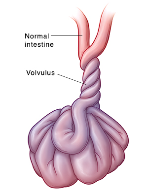 Front view of intestine twisted around itself (volvulus).