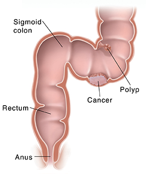 Colorectal Cancer Screening