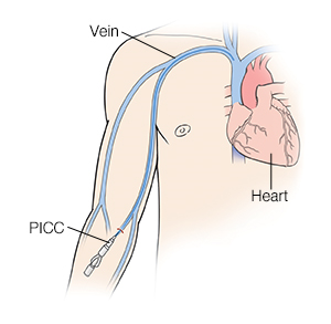 Front view of a man showing heart and veins with catheter inserted in forearm (PICC).