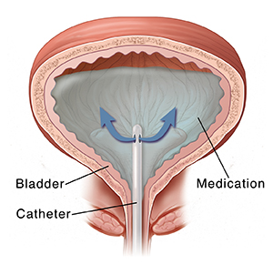 Front view cross section of bladder with catheter inside delivering medication.