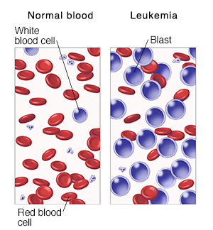 Microscopic view of blood cells comparing normal blood and leukemia.