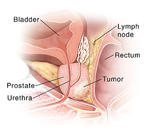 Cross section of prostate gland showing cancer bulging prostate into rectum.