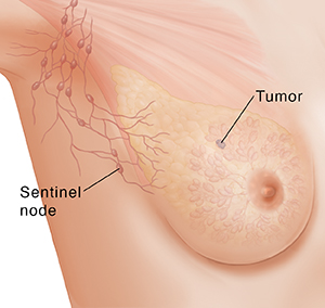 Three-quarter view of female underarm area showing tumor and sentinel lymph node.