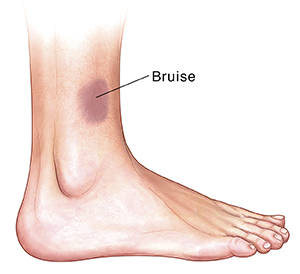 Side view of foot with bruise.