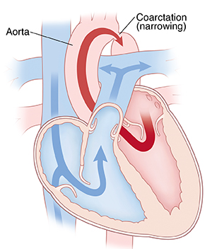 Cross section of heart showing coarctation of the aorta.