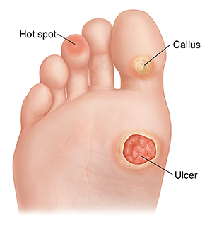Sole of foot showing callus, hot spot, and ulcer.