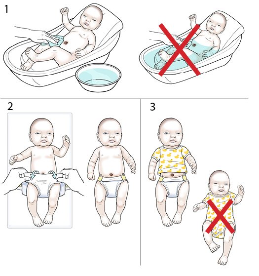 3 steps in caring for a newborn's umbilical cord.