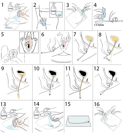 16 steps showing how a female inserts a urinary catheter.
