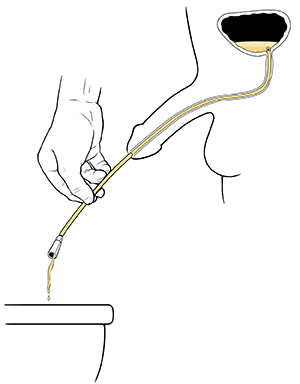 Hand holding catheter draining urine from bladder into toilet.