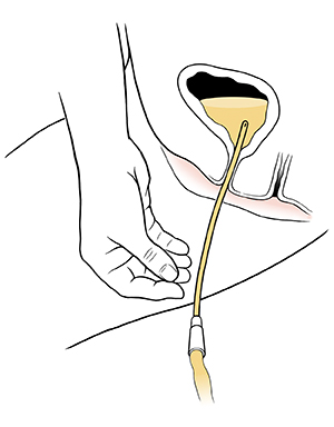 Cross section of catheter in urethra, draining urine from bladder