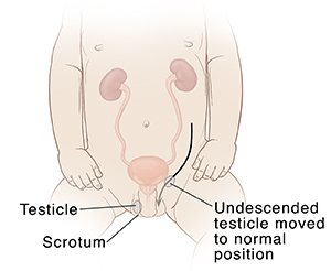 Front view of baby showing genitourinary system with arrow showing testicle being moved to normal position.
