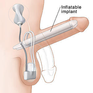 Side view of penis with pump inflatable implant inside.