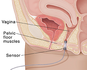 Closeup cross section of female pelvis showing sensor in vagina.