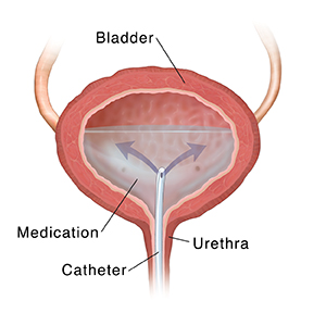Cross section of bladder showing catheter inserted through ureter, releasing medication.