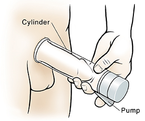 Closeup of male genitalia with hand putting vacuum pump on penis.