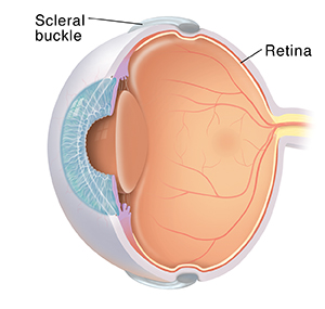Three-quarter view of cross sectioned eye showing scleral buckle around outside of eyeball.