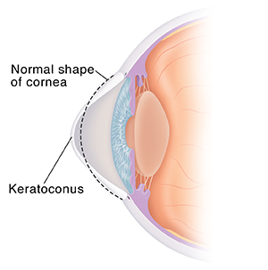 Side view cross section of eye with keratoconus. Dotted line shows normal shape of cornea.