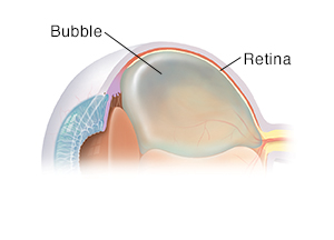 Three-quarter view of cross section of eye showing gas bubble for pneumatic retinopexy.
