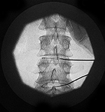 X-ray of spine showing catheters in two disks.