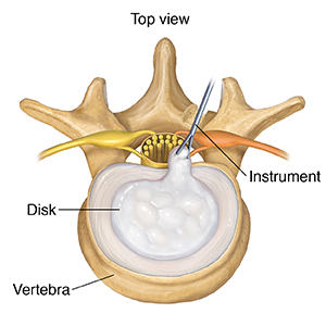 Top view of lumbar vertebra showing posterior removal of herniated disk. 