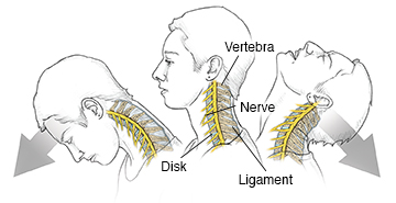 Side view of woman's head and neck showing vertebrae and nerves in neck during whiplash.