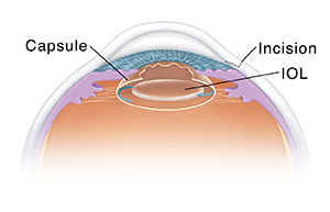 Cross section of eye showing intraocular lens implant.