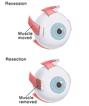 Eye showing muscle moved. Eye showing muscle cut.